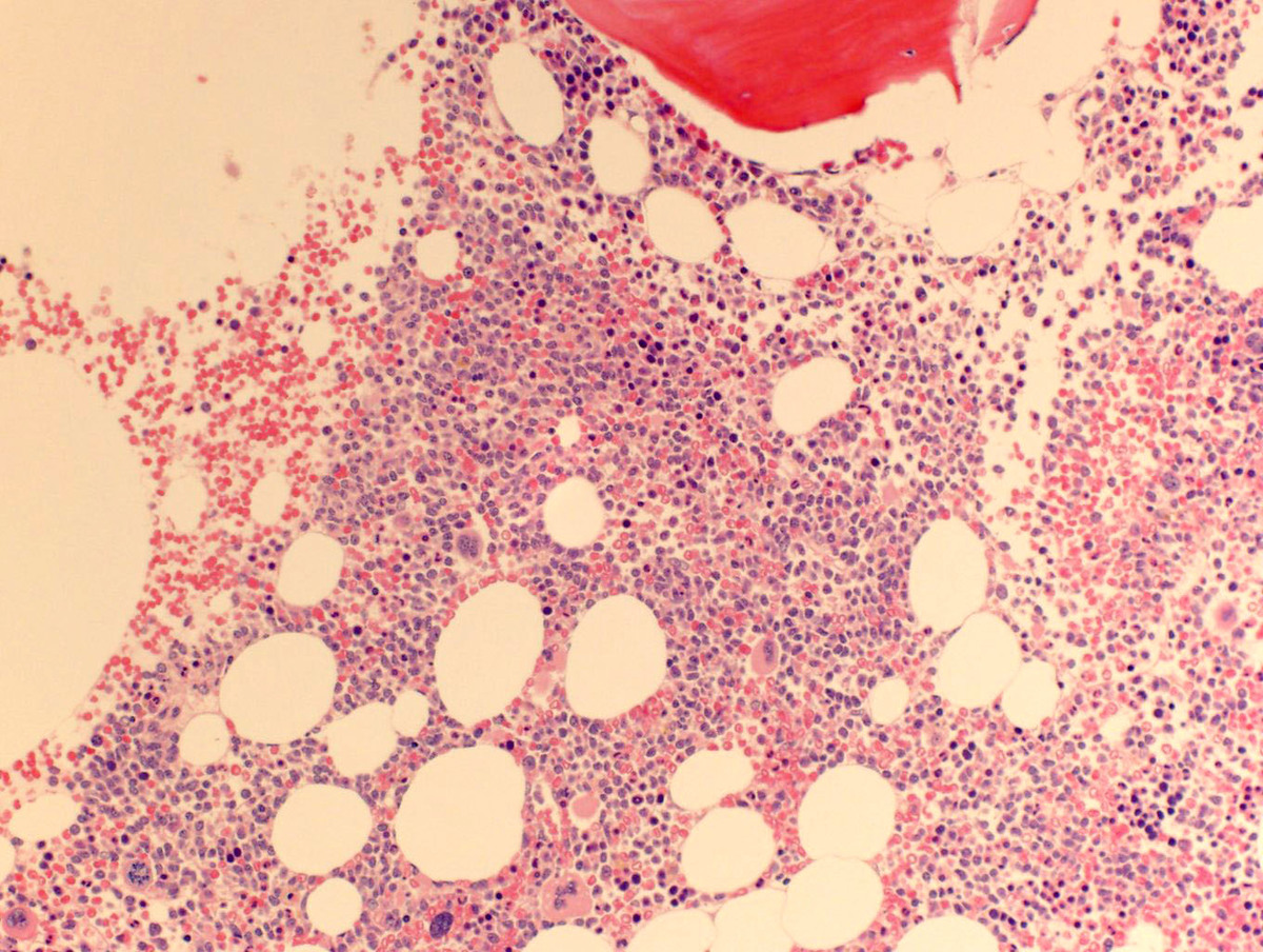 Core biopsy, 10x